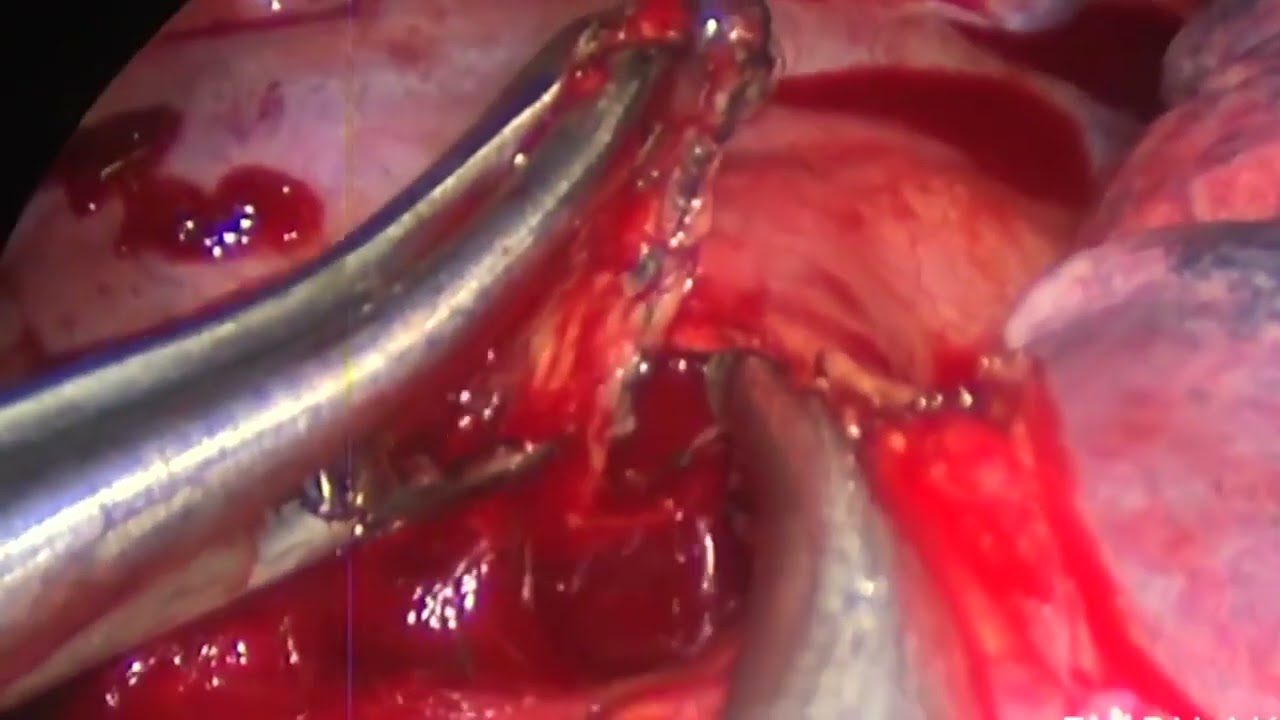 Asvide: Uniportal VATS dissection of subcarinal mediastinal lymph nodes (station 7) from the right…