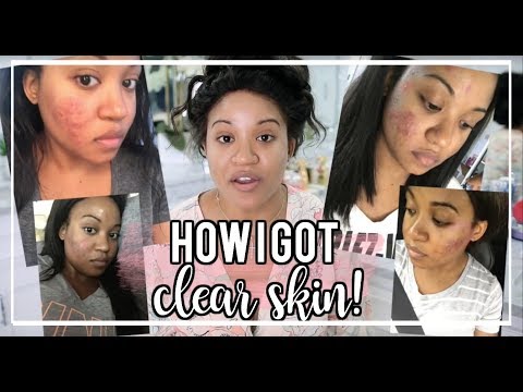 The Skincare Routine that Cleared my Acne and Dark Spots! | ft. FOREO LUNA mini 