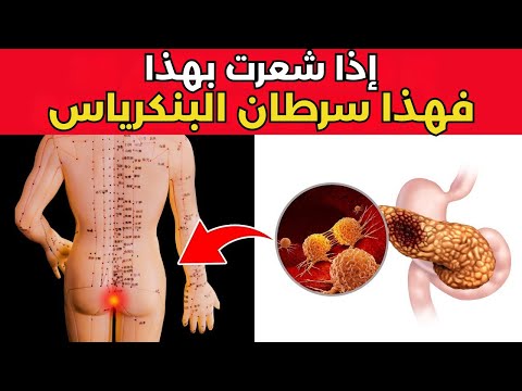 10 علامات غريبة تشير إلى إصابتك بسرطان البنكرياس 