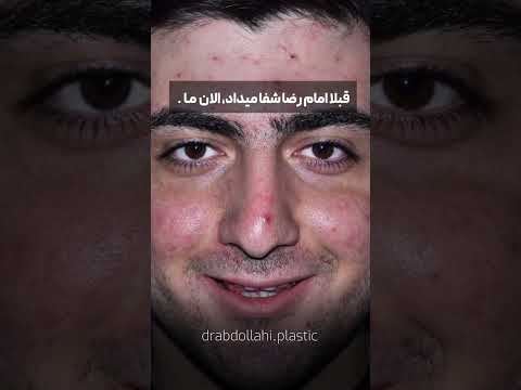 شفا گرفت جراحی زیبایی بینی دماغ بیمار بیمارستان زیبایی ترند زیبا