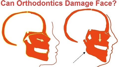 Can Orthodontics Damage Faces by Prof John Mew