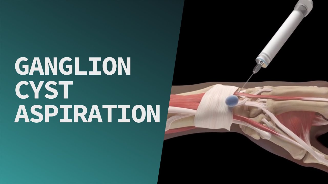 Can I Drive After Ganglion Cyst Surgery