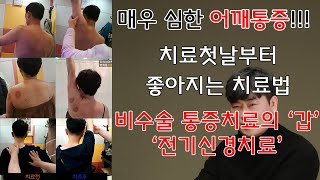 매우 심한 어깨 회전근개파열통증!! 치료첫날부터 좋아지는 치료법 !! 최고수준의 비수술 통증치료 &#39;전기신경치료&#39;를 소개합니다.