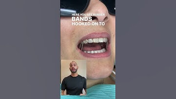 Overbite, rubber bands, and Invisalign.