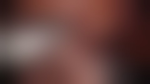 Laparoscopic Left Lateral Sectionectomy | Left Lobectomy