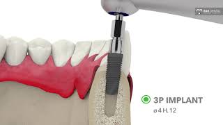B&B Dental | Drilling protocol - D1-D2 bone - 3P implant line
