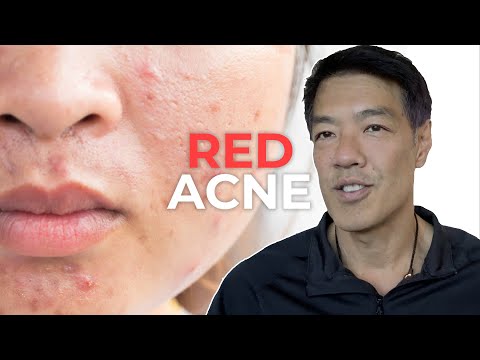 Everything about Red Acne Scars