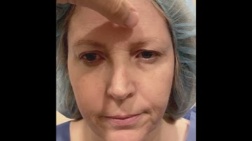 Before and After Endoscopic Brow Lift and Blepharoplasty Surgery.