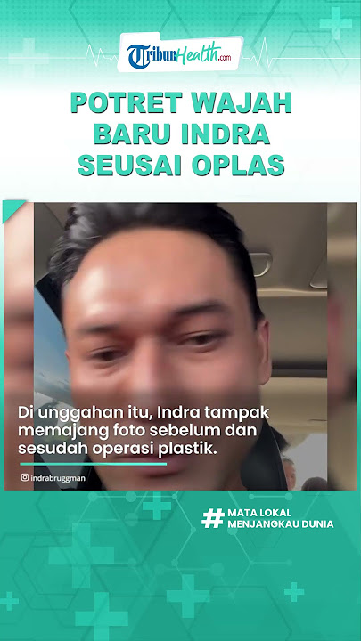 Idap Hipertiroid hingga Jalani Operasi Plastik Mata, Begini Penampakan Wajah Baru Indra Bruggman