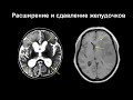 Поражения головного мозга на МРТ