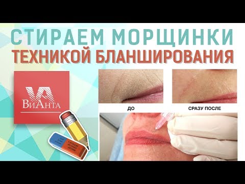 #Бланширование (лечение морщин)