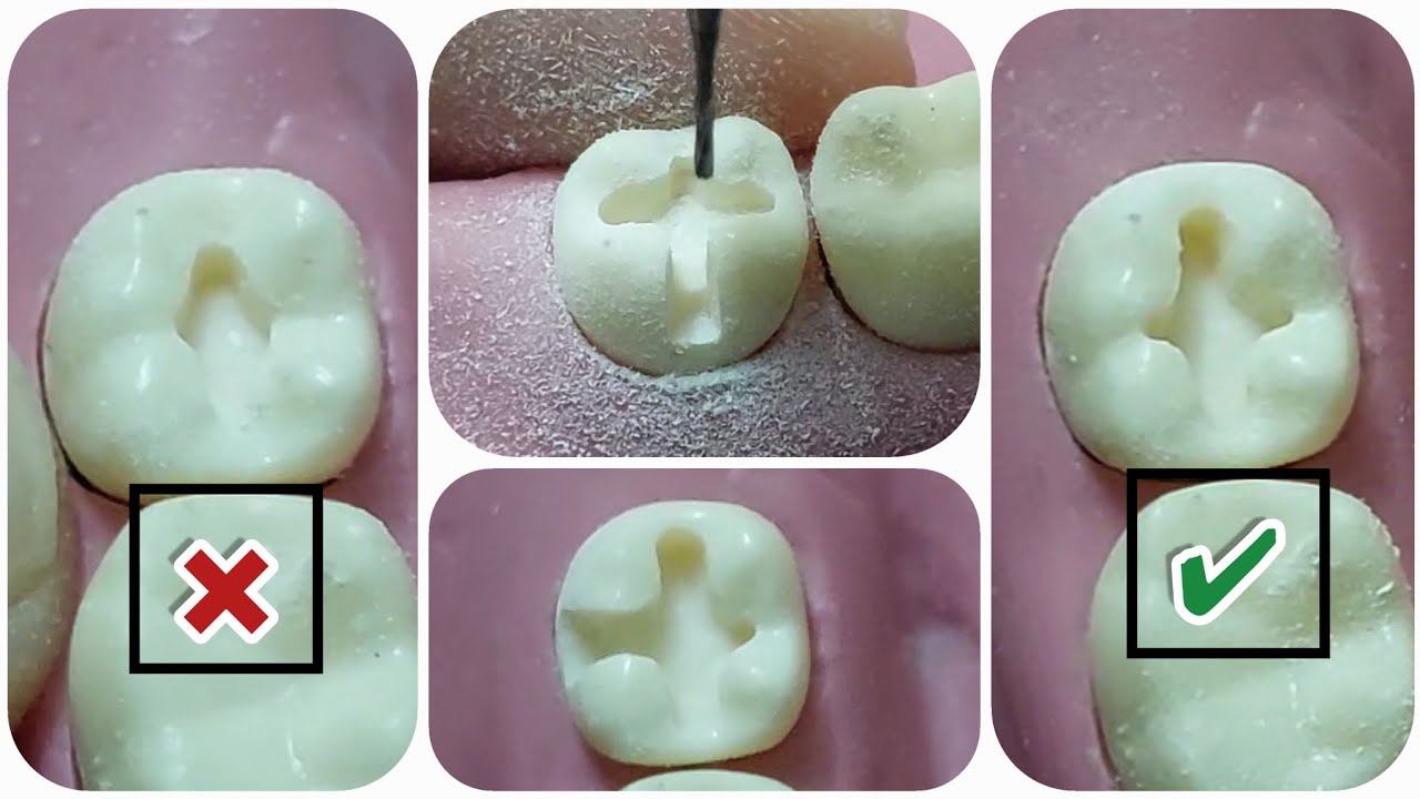 اسهل فيديو class I cavity preparation with baccal extension _ وازاى تطور من شغلك وتقيمه...!!