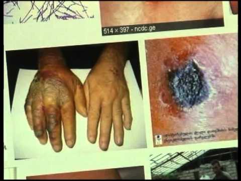 საქართველოში „ჯილეხის\" შემთხვევებმა იკლო