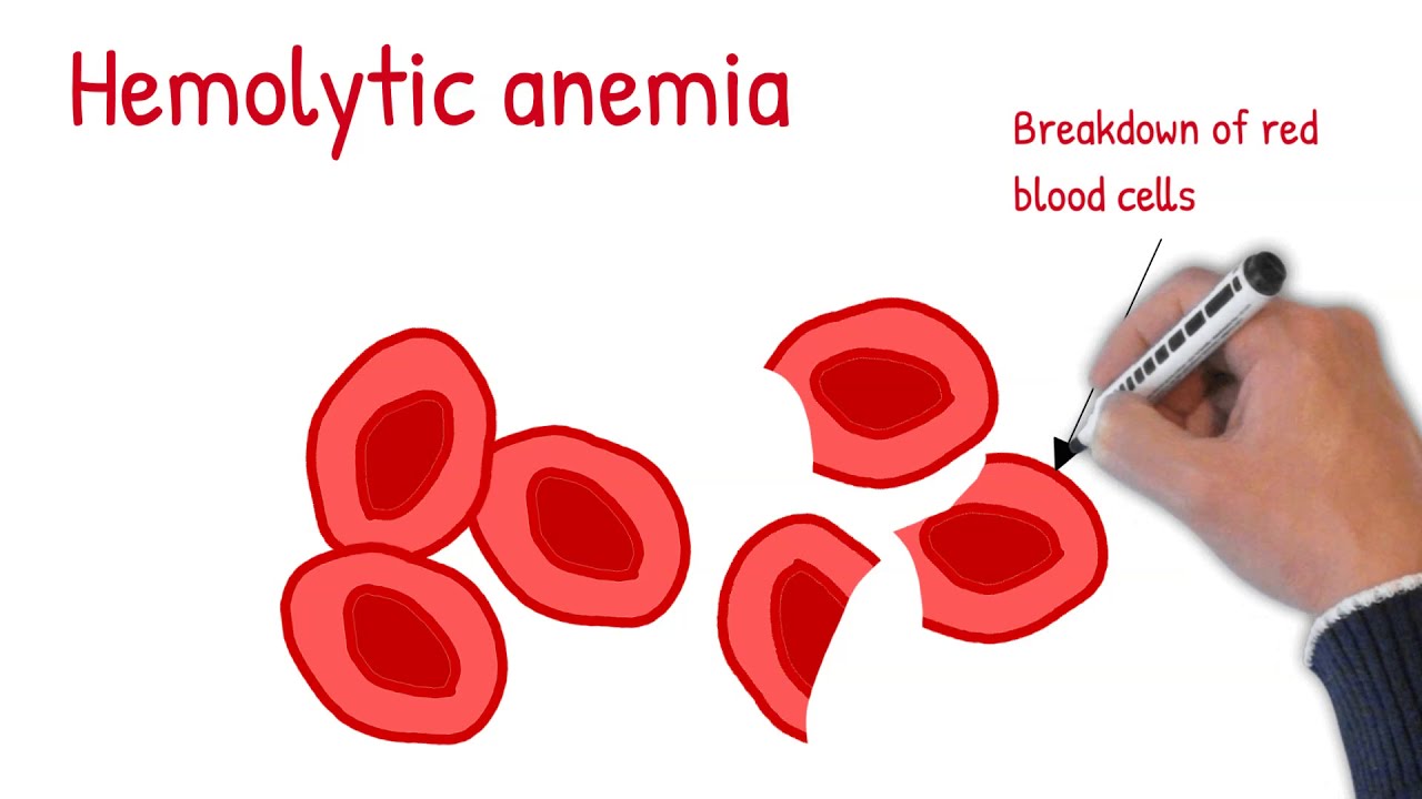 Hemolytic anemia made easy; Intrinsic vs extrinsic hemolytic anemia -  YouTube