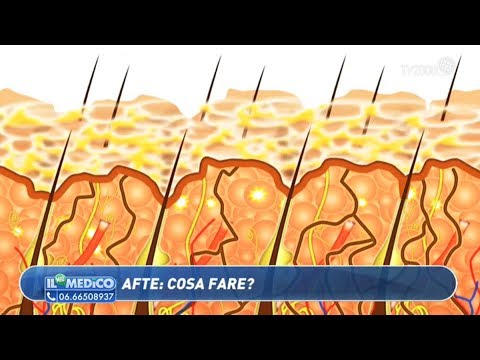 Video: Ecco Cosa Sta Realmente Succedendo Nel Tuo Corpo Quando Hai Le Afte