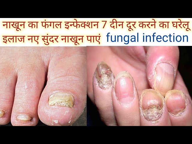 नेल फंगस ट्रीटमेंट इन ह‍िंदी | नेल फंगस का उपचार | fungal nail infection, Nail  Fungus treatment hindi, Nail Fungus treatment home remedies, नेल फंगस का  घरेलू उपचार, नेल फंगस क इलाज,