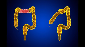CPT code for Colectomy partial - simplify medical coding