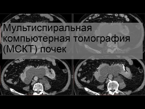 Мультиспиральная компьютерная томография (МСКТ) почек