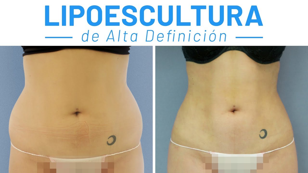 lipoescultura