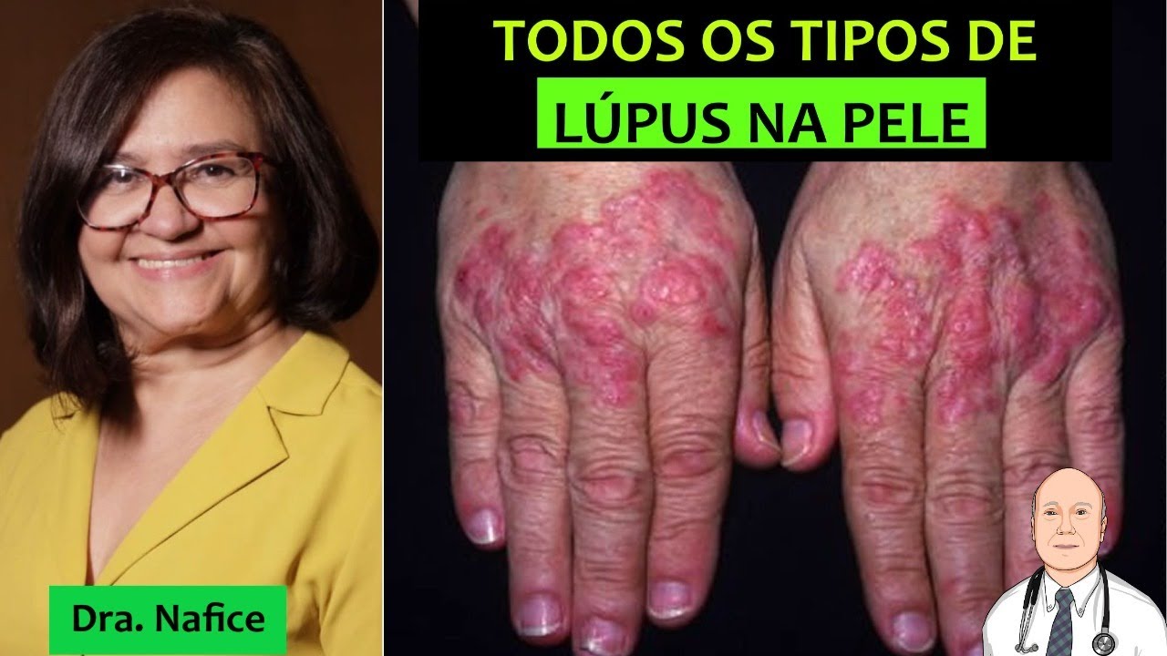 Lesões de pele do lúpus: os diversos tipos de lúpus cutâneo, como prevenir e como tratar