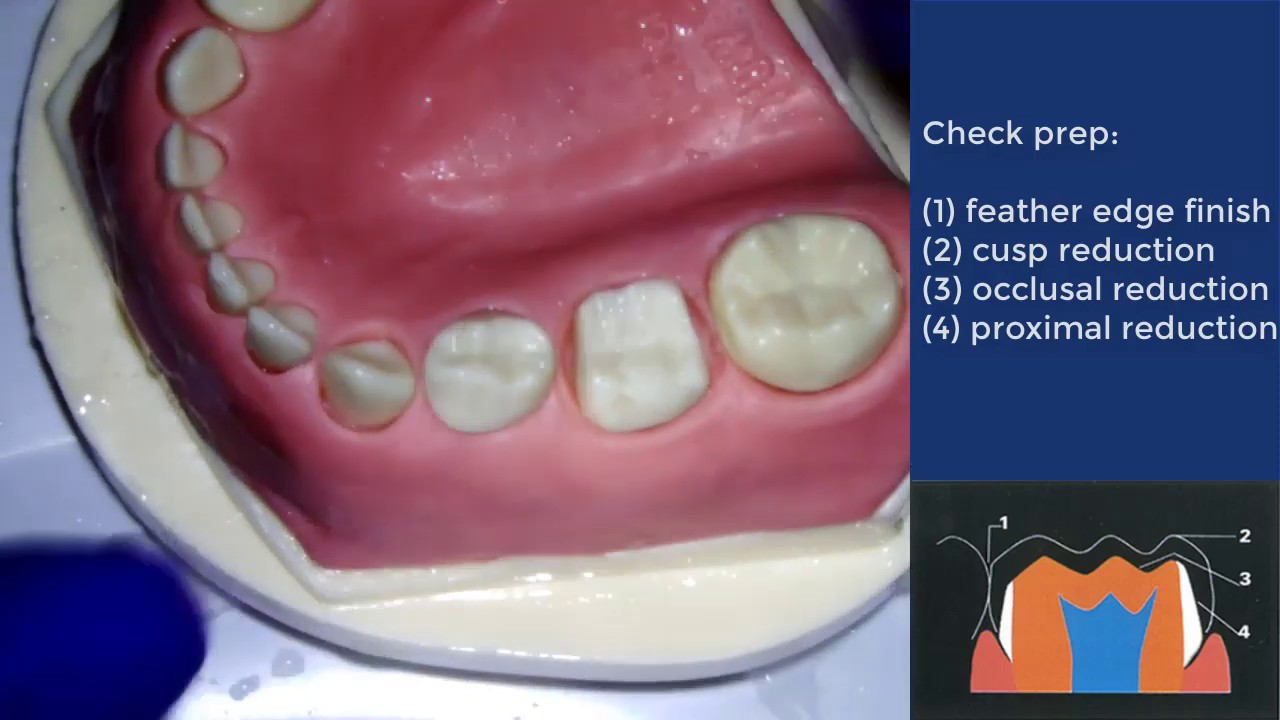 Conventional crown preparation for PMC Institute of Dentistry QMUL