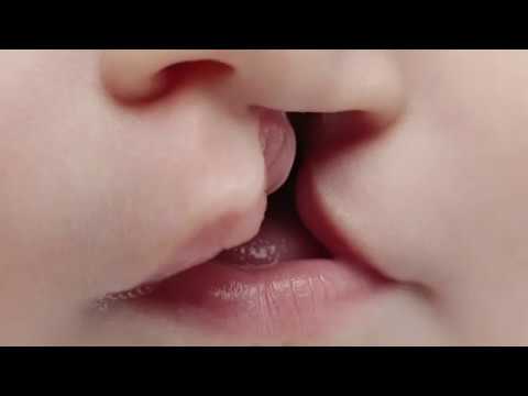 कटे होंठ और तालू - एक्रोन चिल्ड्रेन हॉस्पिटल वीडियो