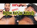 Regrow Hairline Naturally DERMA ROLLER for Hair Growth For Men & Women || हिंदी में  P SQUARE SALON