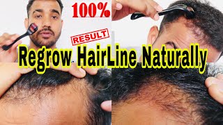 Regrow Hairline Naturally DERMA ROLLER for Hair Growth For Men & Women || हिंदी में  P SQUARE SALON