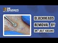 Deep Big Blackheads Removal By Dr LAlit Kasana