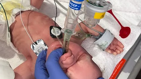 Laryngeal Mask Airway Placement in Neonates@McGlinnInstituteNeonatal