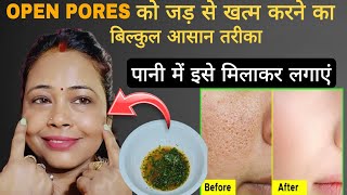 कितना भी पुराना OPEN PORES/ LARGE PORES हो बस पानी में ये मिलाकर लगाएं 100% छुटकारा पाएं