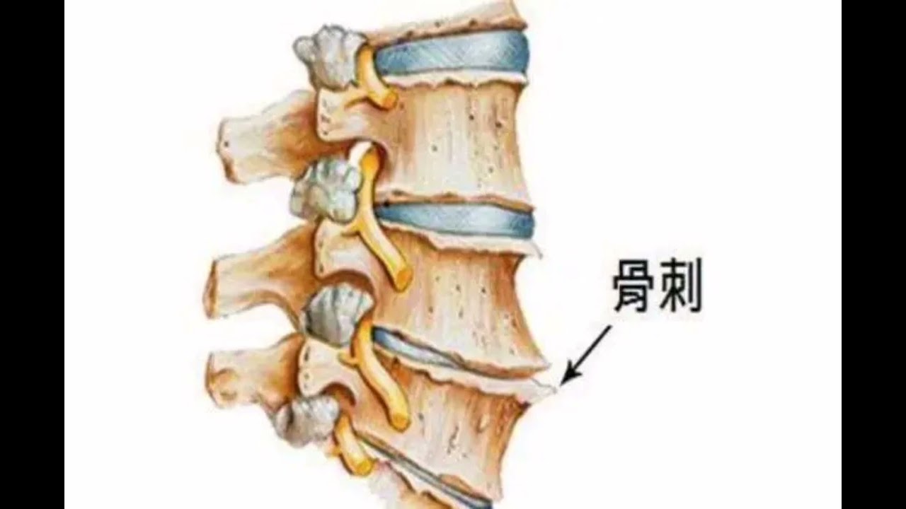 Острый хондроз позвоночника. Острый хондроз шейного. Острый хондроз шейного позвонка. Соли в межпозвоночных дисках