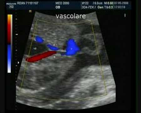 Onfalocele immagini Onfalocele immagini