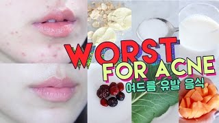WORST FOODS FOR ACNE! • Get Rid of Hormonal Acne Naturally 🌴 Liah Yoo