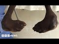 How clubfoot treatment is transforming senegalese childrens lives  bbc news