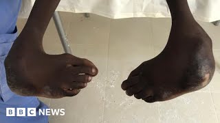 How clubfoot treatment is transforming Senegalese children's lives - BBC News