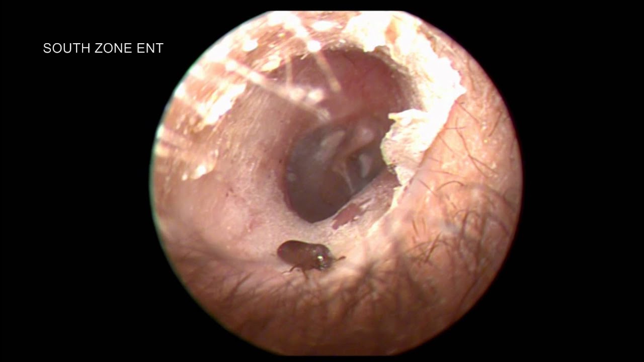 THE MISSING BEETLE INSIDE THE EAR - YouTube