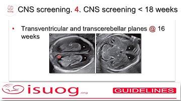 ISUOG guidelines on the sonographic examination of the fetal CNS (part 1)