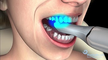 Restorative Intraoral Scan Process Flow