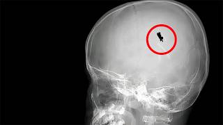 His skull was healed by a-