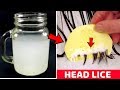 How to get rid of lice eggs in hair permanently in one day naturally with vinegar