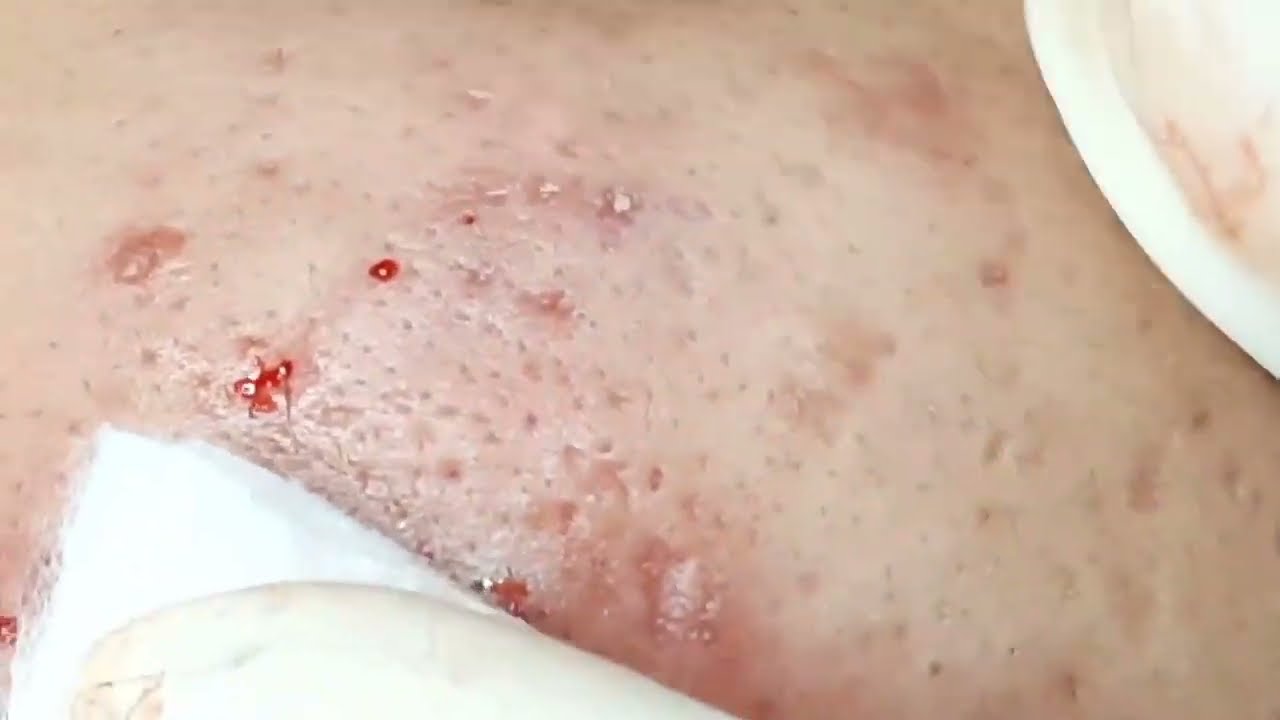 HHV Clinic | Đỗ Thu Hiền | Hiền Vân Spa-These moments in acne extraction