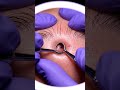 ✨ Eyebrow Blackhead Pop You Have to See! 😮