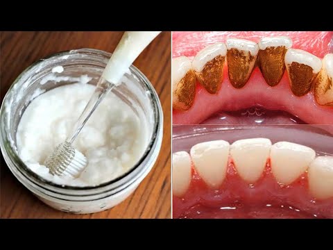 Video: A i zbardh dentisti dhëmbët tuaj?