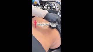 Fat &amp; Cellulite Reduction : Venus Legacy #shorts
