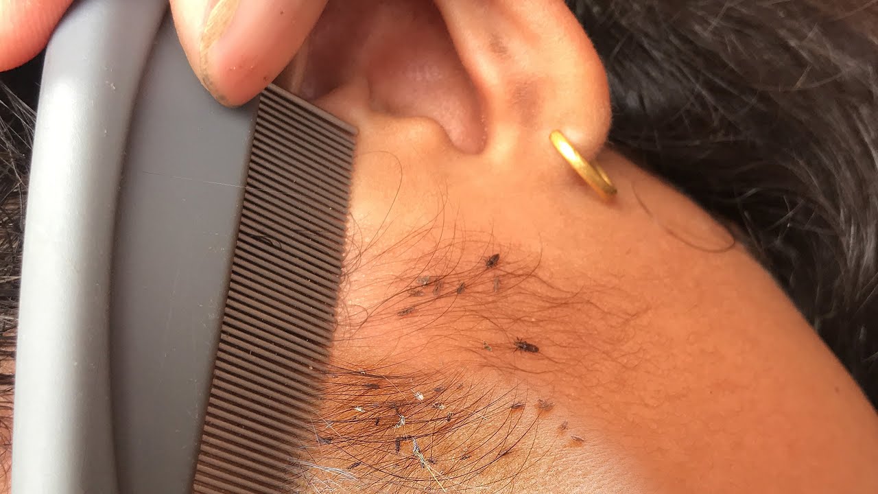 Removing Thousand of Lice From Head Using Comb And Taking All Lice