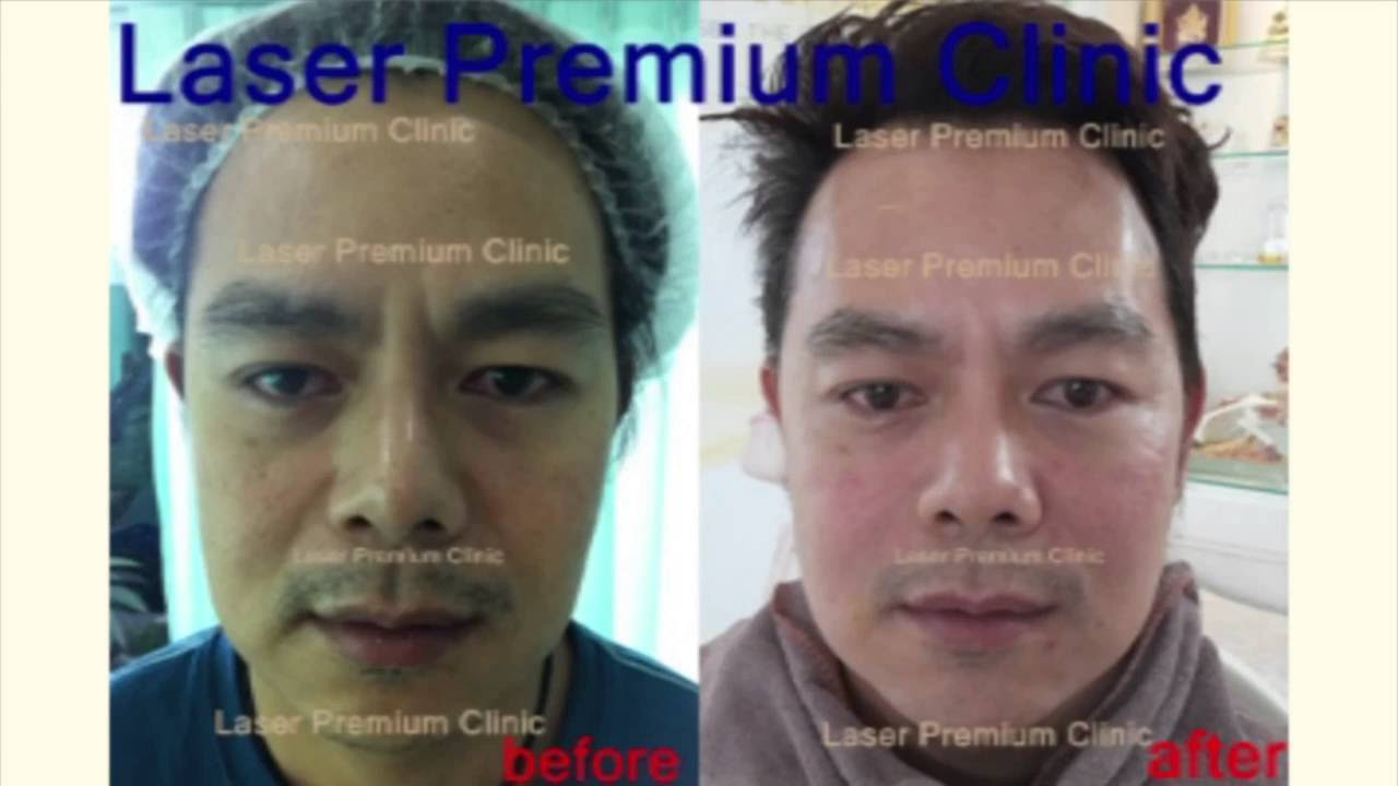 บริการ ต่างๆ  Update 2022  Laser Premium Clinic Review  รีวิวการบริการต่างๆในคลีนิก เลเซอร์พรีเมียมคลินิก ภูเก็ต