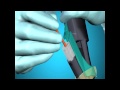Procedural animation advanix biliary stent with naviflex rx delivery system
