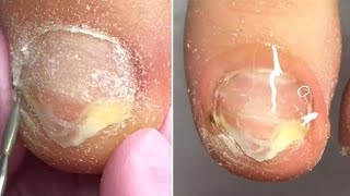 Most Satisfying Pedicure and Ingrown Nail Treatment #4