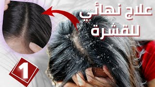 أسرع وصفة لعلاج قشرة الشعر نهائيا